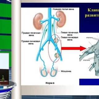 Варикоцеле код