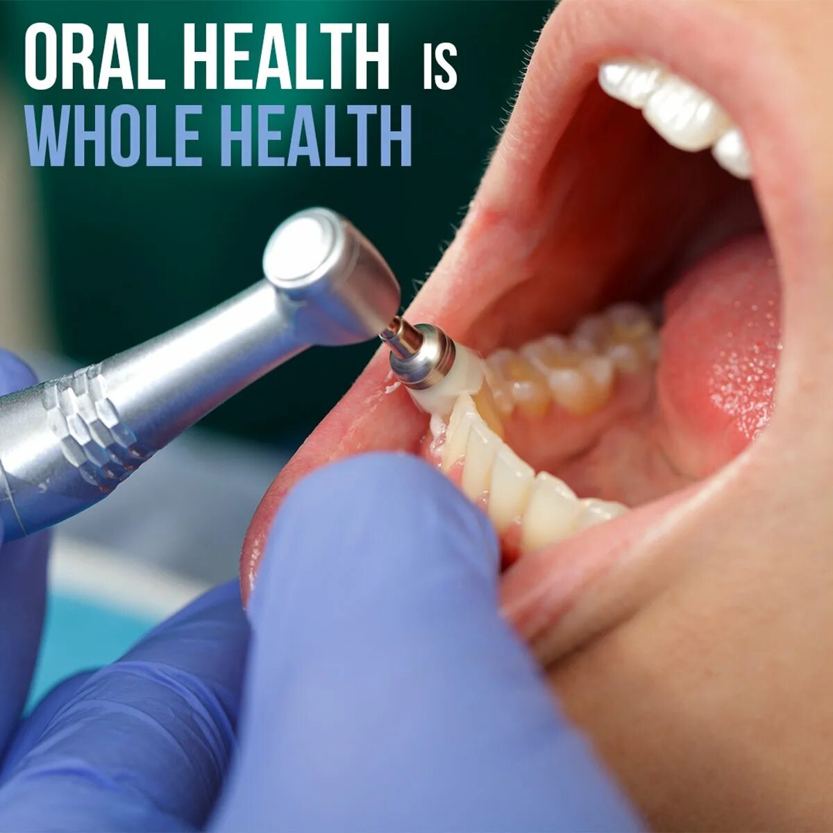 Проф гигиены полости рта. Профгигиена (ультразвук + Air-Flow). Профессиональная гигиена полости рта. Профессиональная гигиена полости рта в стоматологии.