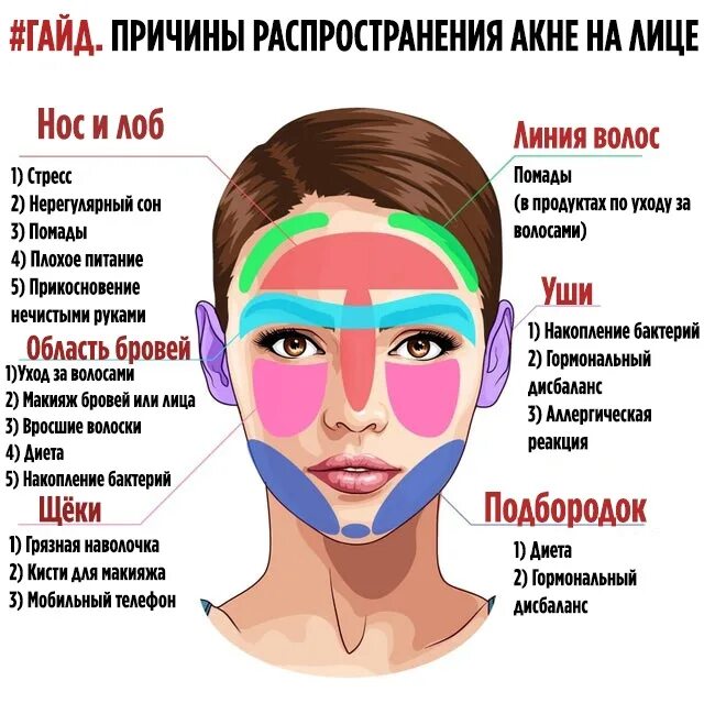 Причины прыщей после 30. Прыщи на лице по зонам причины. Зоны появления прыщей на лице. Локализация прыщей на лице. Схема прыщей на лице.