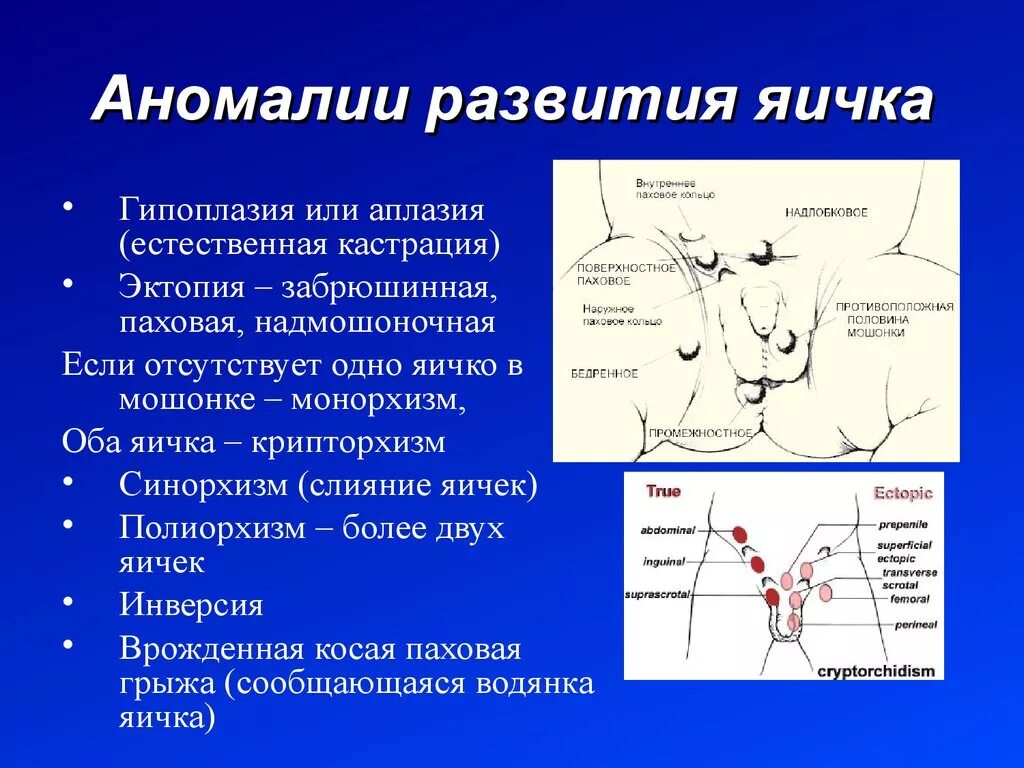 Аномалии положения яичка. Пропадает яичко