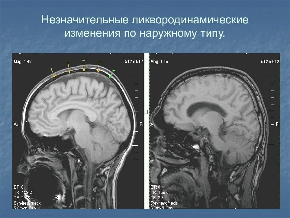 Лечение наружная гидроцефалия мозга