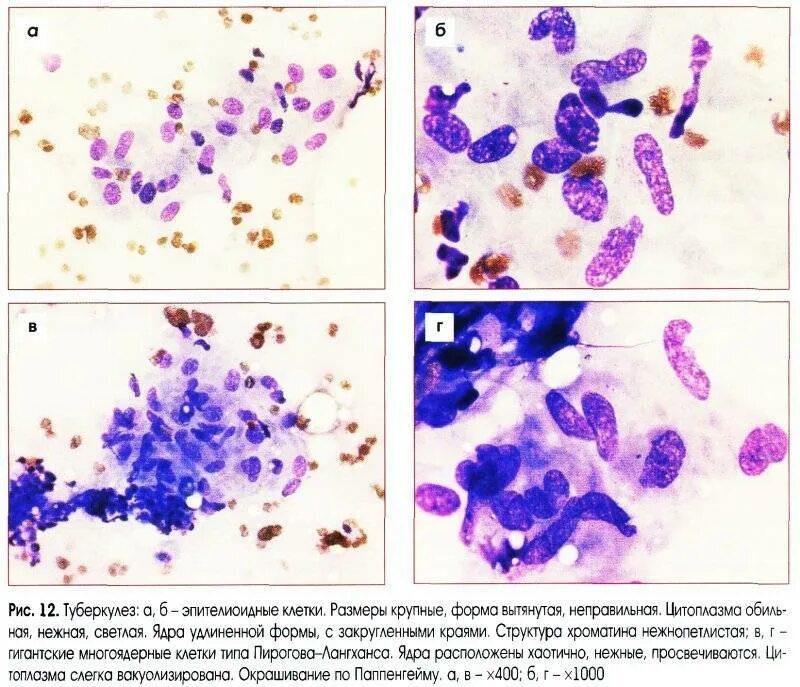 Цитологическое исследование пунктата. Пунктат лимфатического узла цитология. Микроскопия мазка мокроты. Исследование мокроты цитология. Микроскопия мокроты атлас.