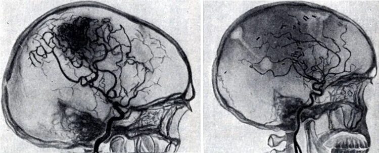 Сосудистая аномалия. Кт ангиография аневризма головного мозга. Мальформация сосудов головного мозга кт. Кровоизлияние кт ангиография головного мозга.