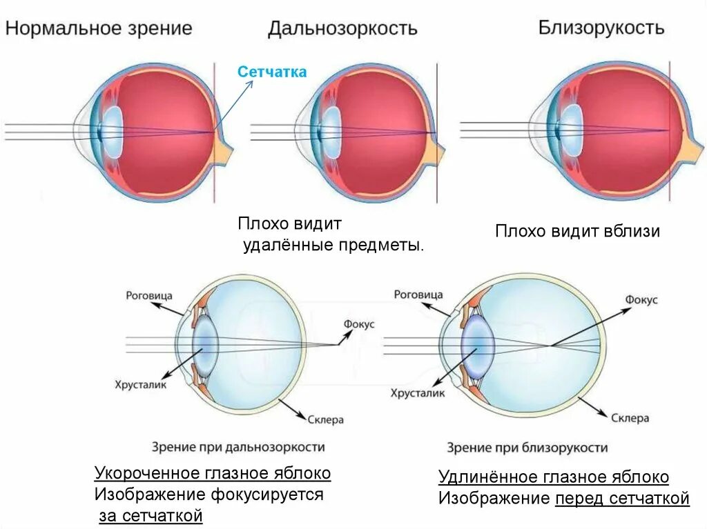 10 лет зрение 2. Дальнозоркость и близорукость строение глаза. Нормальное зрение близорукость дальнозоркость схема. Форма глазного яблока при миопии. Строение глаза дальнозоркость.