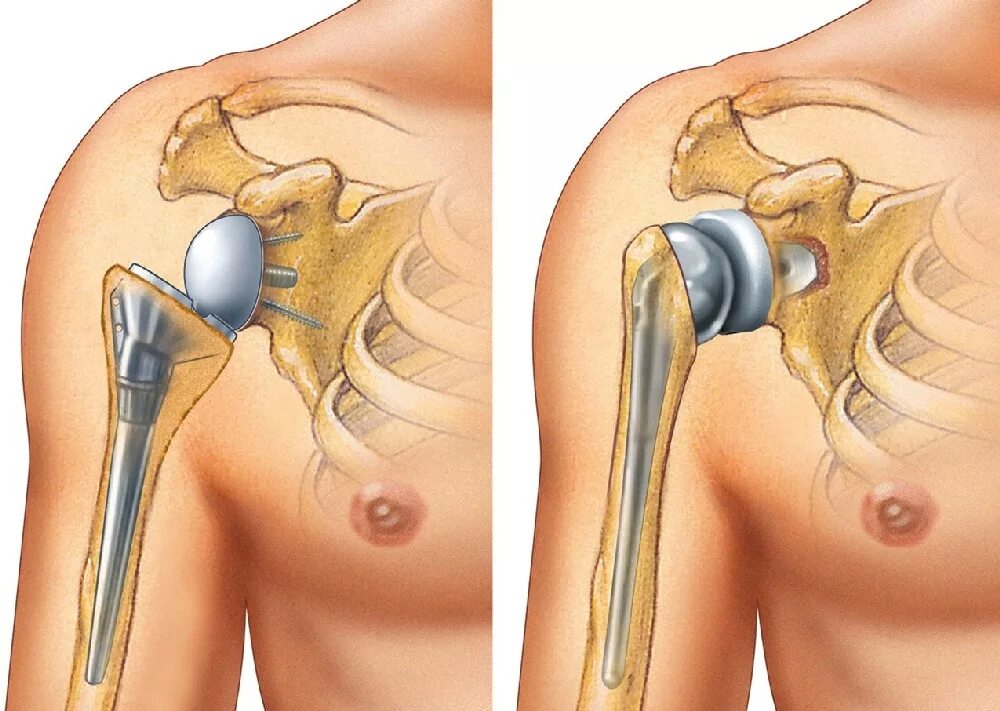 Эндопротез шейки плечевой кости. Тотальное эндопротезирование плечевого сустава. Delta Xtend эндопротез плечевого сустава. Реверсивное эндопротезирование плечевого сустава. Замена сустава осложнения