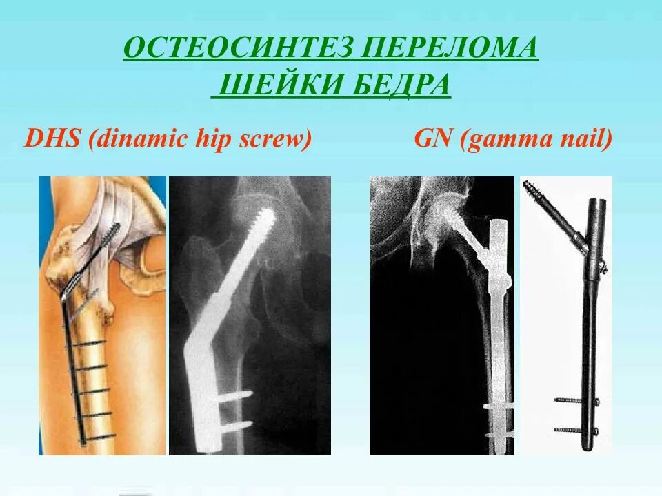 Остеосинтез проксимального отдела бедренной кости. Экстрамедуллярный остеосинтез. Остеосинтез перелома бедренной кости. Перелом шейки бедра интрамедуллярный остеосинтез. Осложнения остеосинтеза