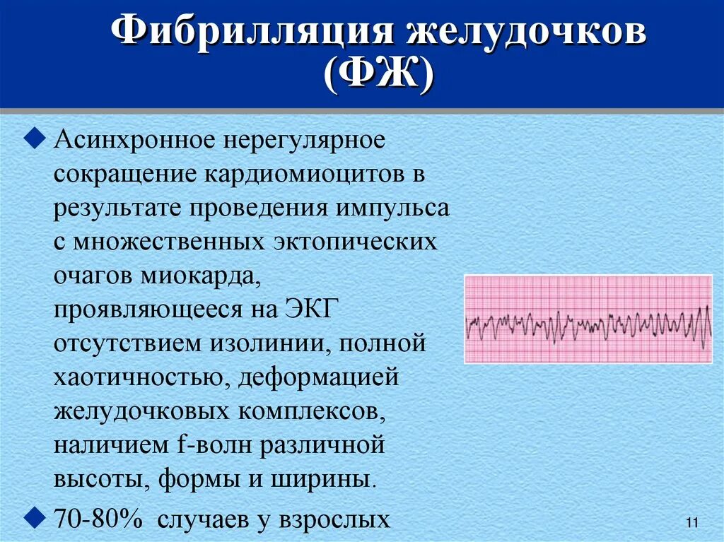 Фибрилляция форум. Возникновению фибрилляции желудочков способствуют. фибрилляция желудочков механизм развития. экг стадии фибрилляции желудочков. мелковолновая фибрилляция желудочков экг критерии.
