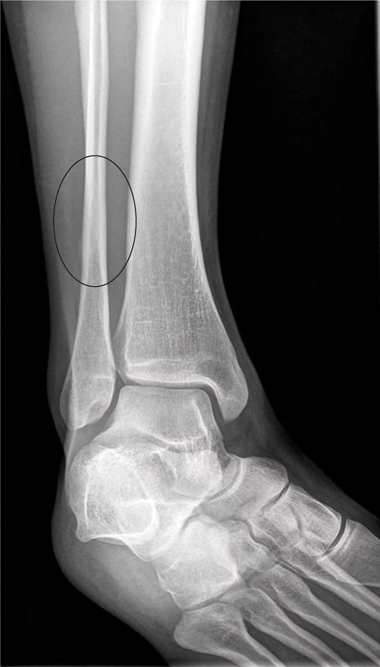 Fracture c
