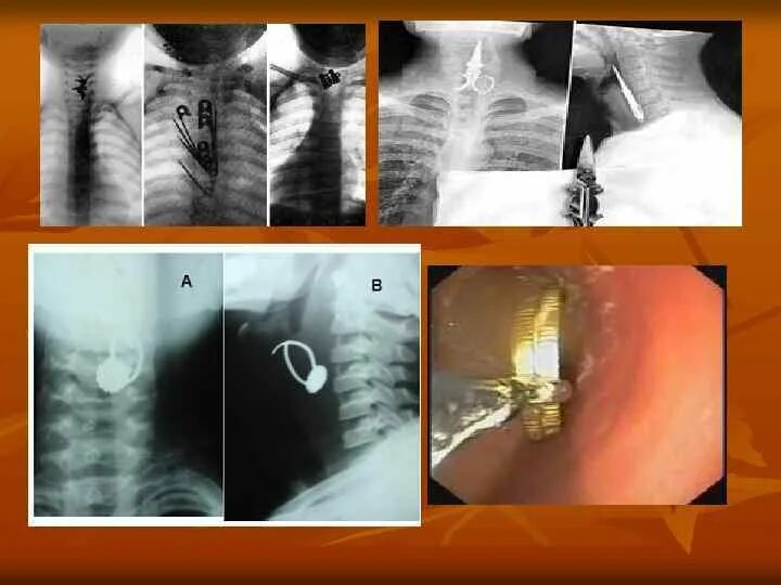 Тело пищевода. Инородное тело пищевода рентген. Инородное тело гортани рентген. Эзофагоскопия инородное тело пищевода. Инородные тела пищевода у детей.