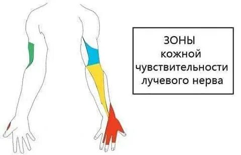 Невралгия лучевой