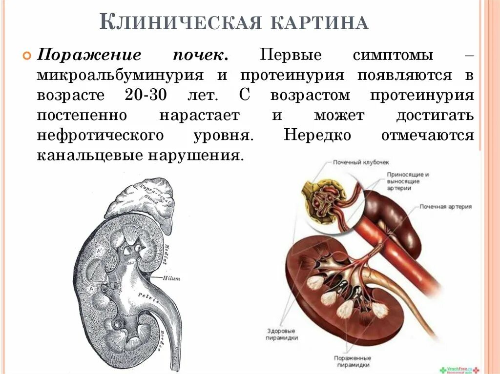 Протеинурия почек. Поражение почек при болезни Фабри. Протеинурия поражение почек. Клинический признак поражения почек. Поражение почек характерно для