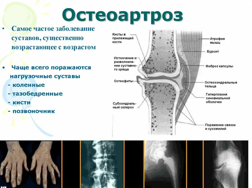 Диагноз доа суставов. .Деформирующий остеоартрит остеоартроз. Схема развития деформирующего остеоартроза. Разрушение суставов и хрящей.