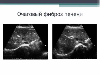Фиброз печени на узи