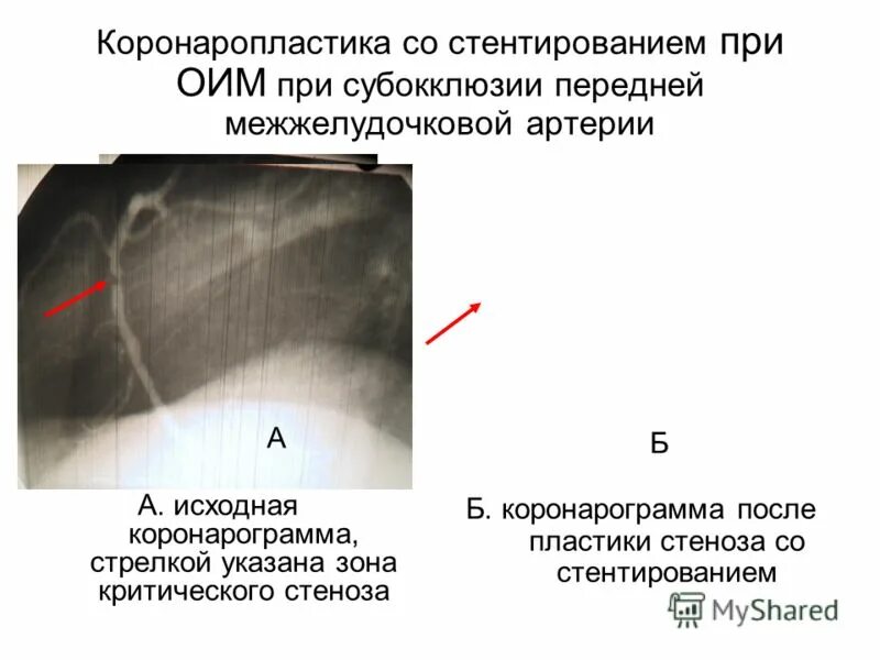 Тромбоаспирация из коронарных. Операция при инфаркте миокарда стентирование. Острый инфаркт миокарда стентирование. Инфаркт миокарда операция стент. Инфаркт миокарда операция стентирование.