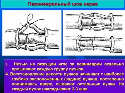 Операция по восстановлению нервов