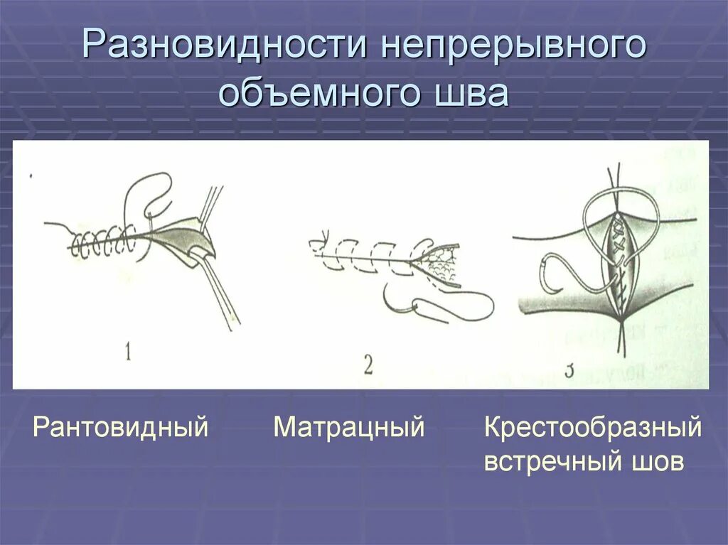 Матрацный шов в хирургии. Непрерывный хирургический матрацный шов. крестообразный шов в хирургии. непрерывный шов топографическая анатомия.