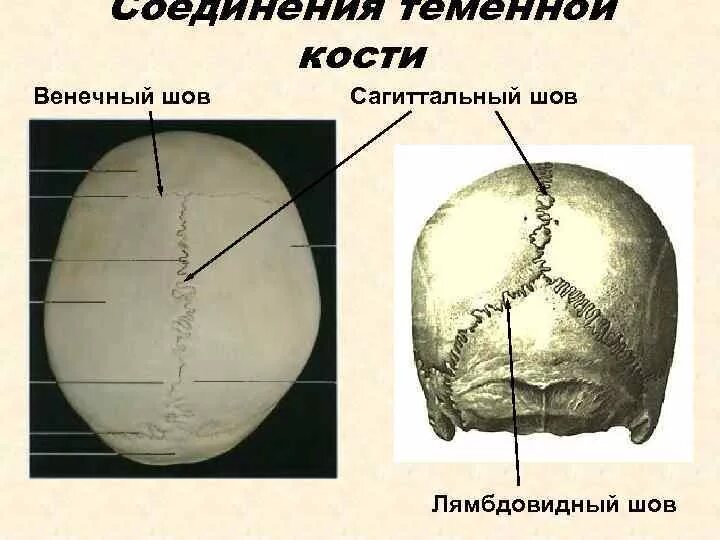 Соединение лобной и теменной кости. Венечный Сагиттальный и ламбдовидный швы черепа. Венечный шов Сагиттальный шов ламбдовидный. Ламбдовидный шов теменной кости. Строение теменной кости черепа человека.