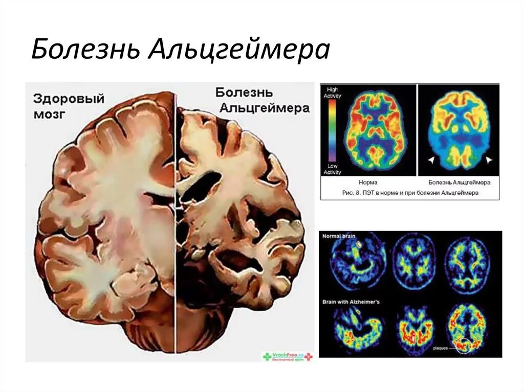 Причины развития альцгеймера. Болезнь альцгеймера. синдром альцгеймера. болезнь альцгеймера мозг. поражение головного мозга.