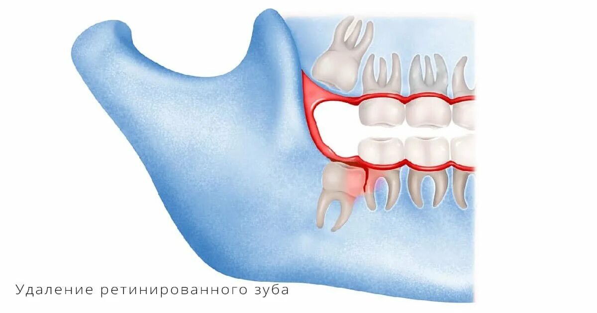 Ретинированный зуб это. Ретинированного постоянного зуба. Удаление ретинированного зуба. Удаление ретинированного, дистопированного, сверхкомплектного зуба.