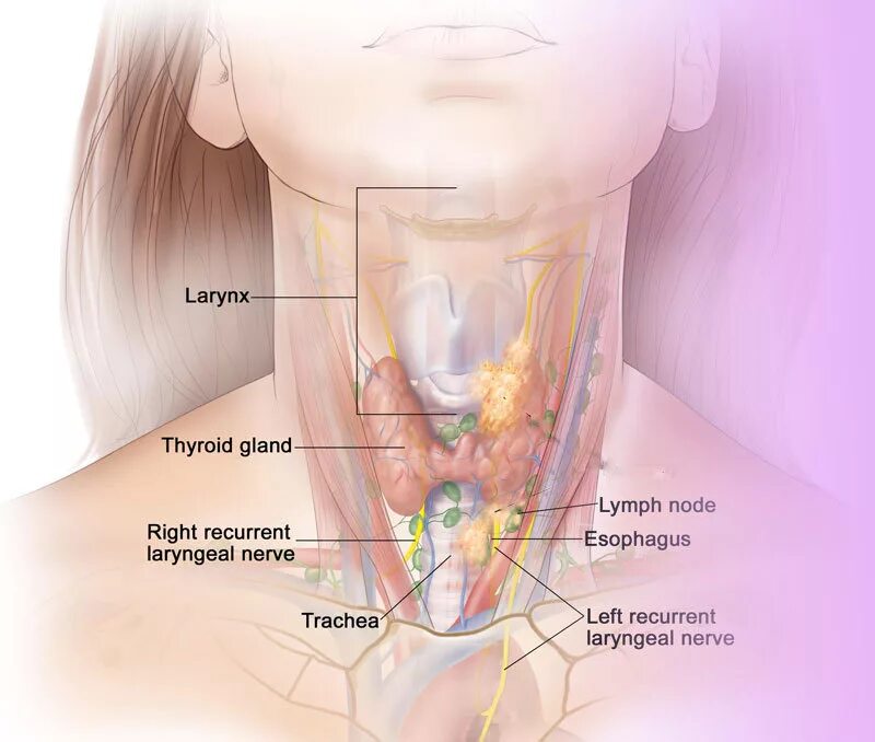 Лимфоузлы щитовидной железы. Щитовидные лимфатические узлы. Лимфоузлы на шее и щитовидная железа. Лимфоузлы на щитовидке