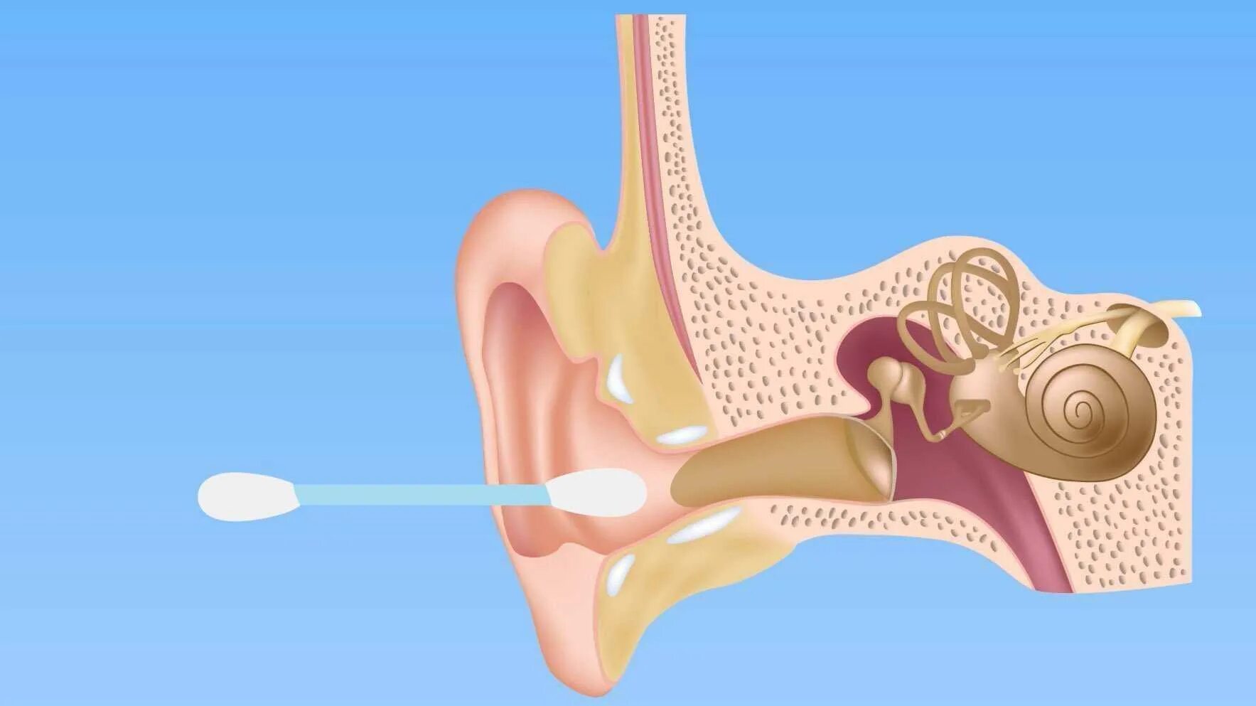 Серная пробка на барабанной перепонке. Наружный отит серная пробка. Серная пробка ватные палочки. Барабанная перепонка отит. Как промыть ухо водой