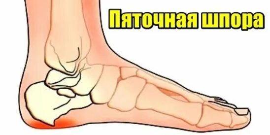 Пяточная шпора проходит сама по себе. Пяточная шпора проходит сама по себе