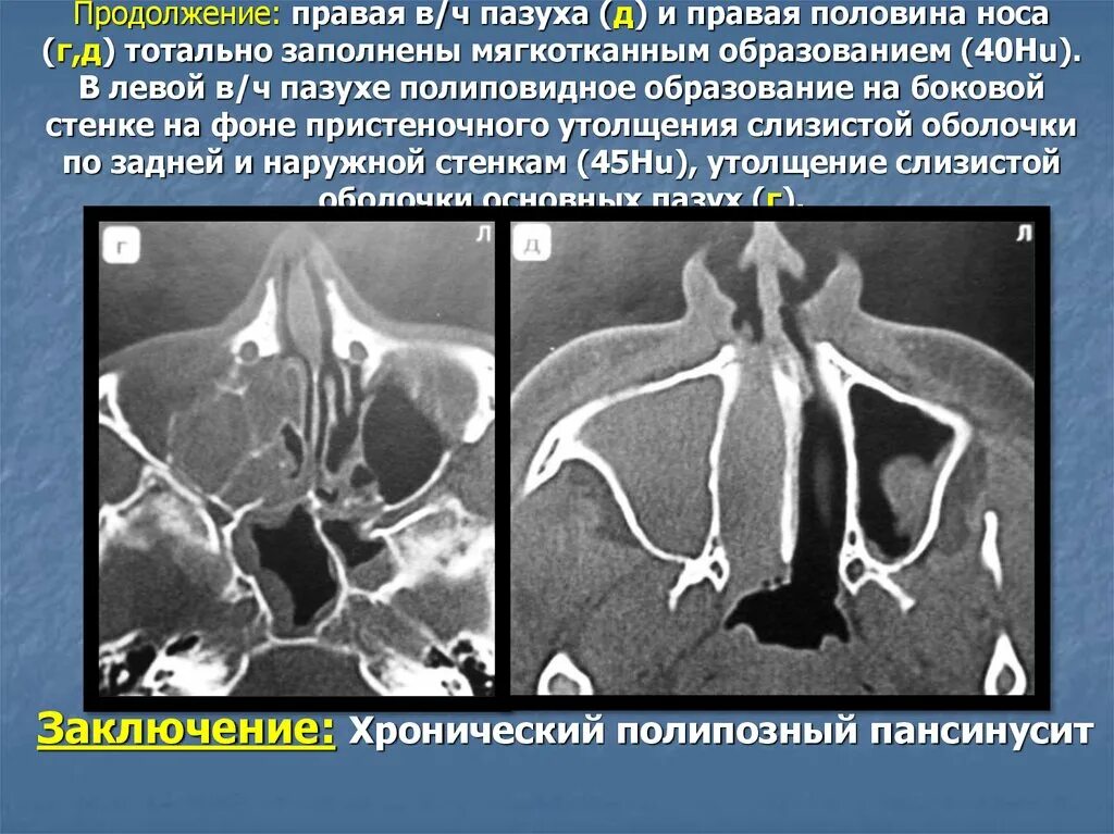 Пристеночный отек слизистой. Пристеночное утолщение слизистой верхнечелюстной пазухи рентген. Утолщение слизистой верхнечелюстной пазухи на кт. Пристеночное утолщение слизистой верхнечелюстной пазухи на кт. Пристеночное утолщение слизистой гайморовых пазух.