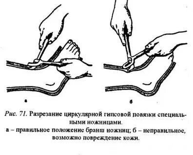 Гипсовая повязка алгоритм