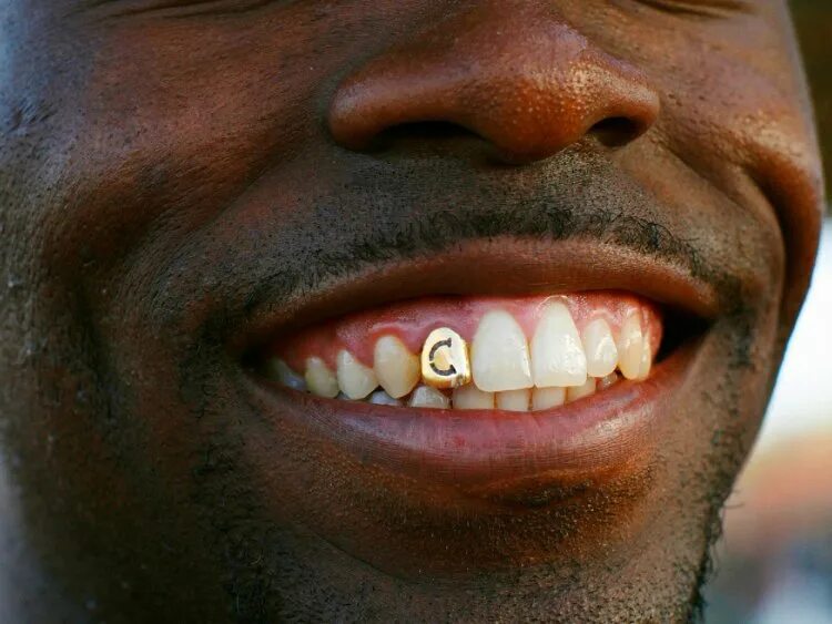 Pointed teeth. Pointed teeth