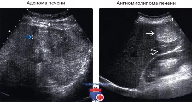 Аваскулярное образование в печени. Образования печени на УЗИ. Очаговые образования в печени на УЗИ. Объемные образования печени на УЗИ.