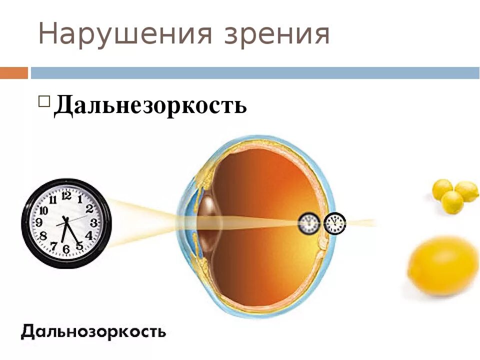 Причины возникновения дальнозоркости. Зрение дальнозоркость. Нарушение зрения дальнозоркость. Профилактика дальнозоркости. Близорукость и дальнозоркость 8 класс.