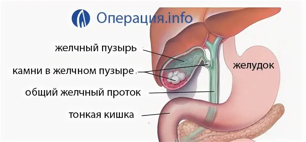 Камни после удаления желчного пузыря симптомы