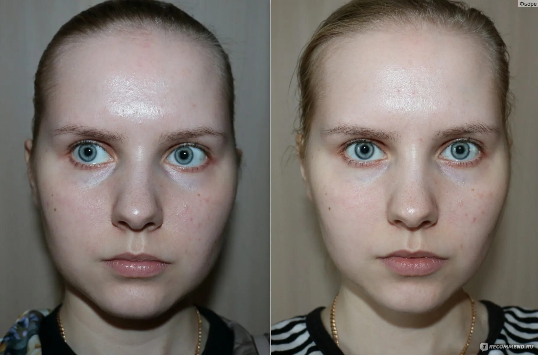 Вакуумная чистка до и после. Вакуумная чистка лица фото до и после. Repart PG фото до после.