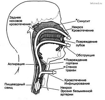 Повреждение гортани