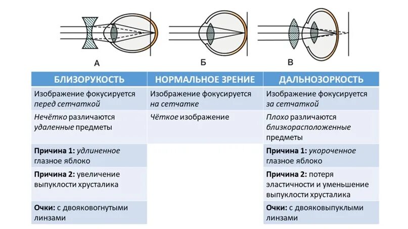 Фокусировка лучей света на внутренней поверхности глазного. Аномалии рефракции глаза близорукость дальнозоркость таблица. Близорукость и дальнозоркость биология 8 класс. Таблица дефект зрения близорукость дальнозоркость. Миопия дальнозоркость астигматизм.