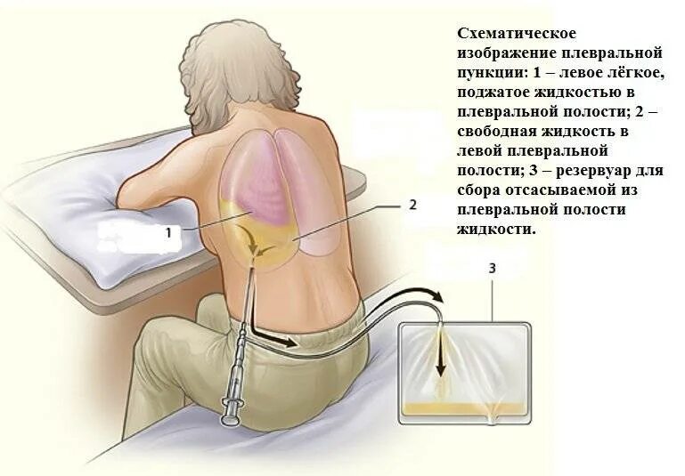 Почему после операции скапливается жидкость
