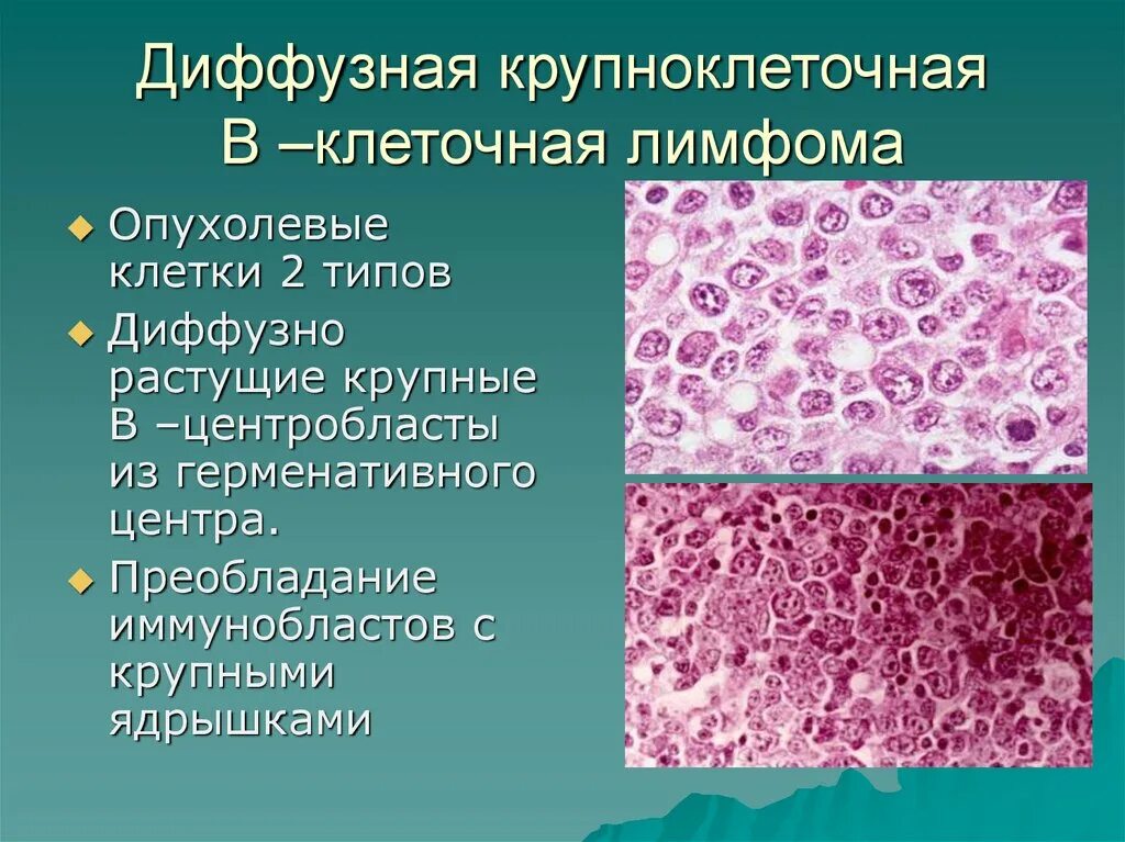 Диффузная неходжкинская. Клетки Ходжкина гистология. Диффузная б клеточная лимфома. B клеточная лимфома микропрепарат. Диффузная в-крупноклеточная лимфома микропрепарат.