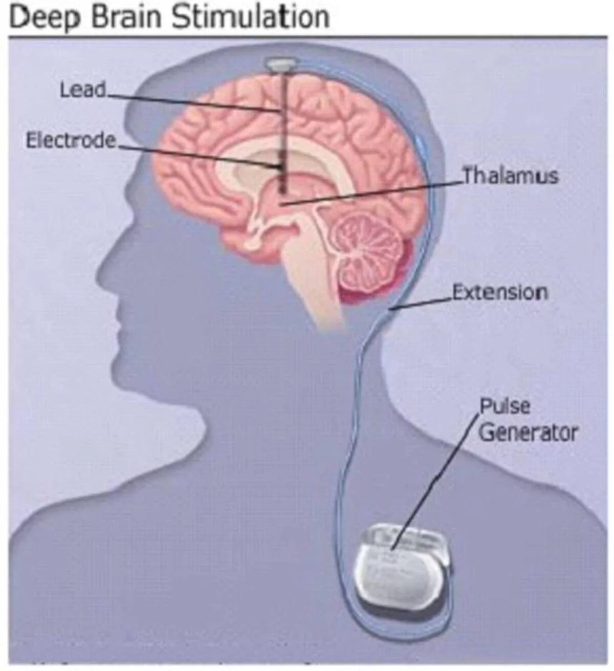 Deep brain. Глубокая стимуляция мозга при болезни Паркинсона. Электроды в головной мозг. Имплантация электродов в мозг. Нейростимулятор головного мозга.