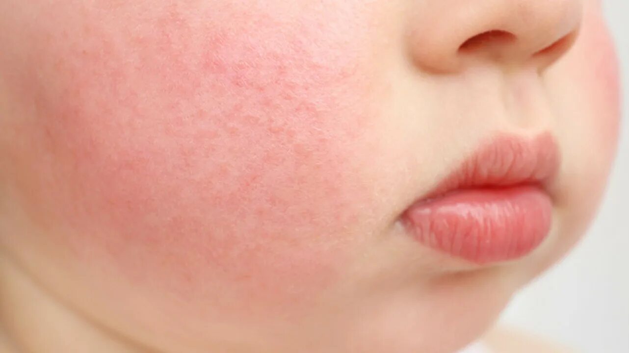 Детский кожный. Аллергическая сыпь на щеках у ребенка. Пищевая аллергия на щеках у грудничка.
