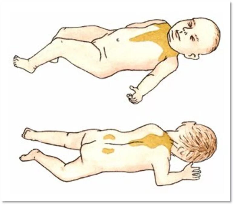 Бурая жировая ткань у новорожденных локализация. Бурая жировая ткань локализация. Локализация бурой жировой ткани у новорожденных. Бурый жир. Функции бурого жира в организме человека.