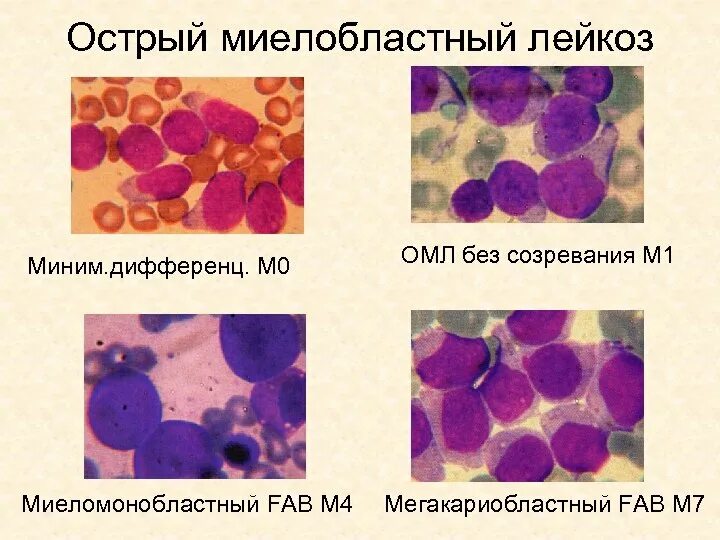 Острый миелоидный лейкоз прогноз. Острый миелобластный недифференцированный лейкоз (м0). Острый миеломонобластный лейкоз м4. Острый миелобластный лейкоз без созревания.