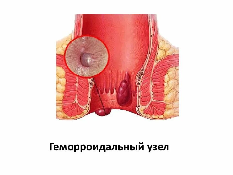 Боли внутри заднего прохода. Наружный геморрой тромбоз. Тромбированный внешний узел геморрой. Выпадение геморройных узлов.