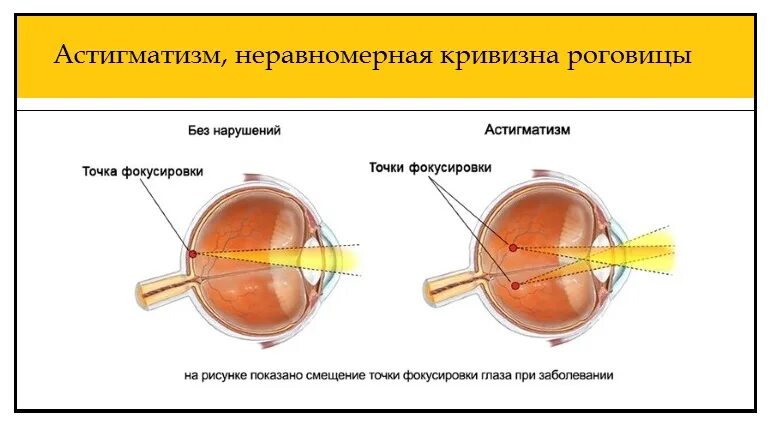 Расплывчатое изображение близкорасположенных предметов