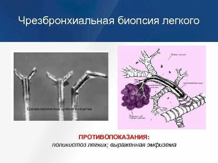 Как делают биопсию легких. Чрезбронхиальная биопсия легкого. Трансбронхиальной биопсии. Щипцовая биопсия бронхов. Трансторакальная биопсия легкого.