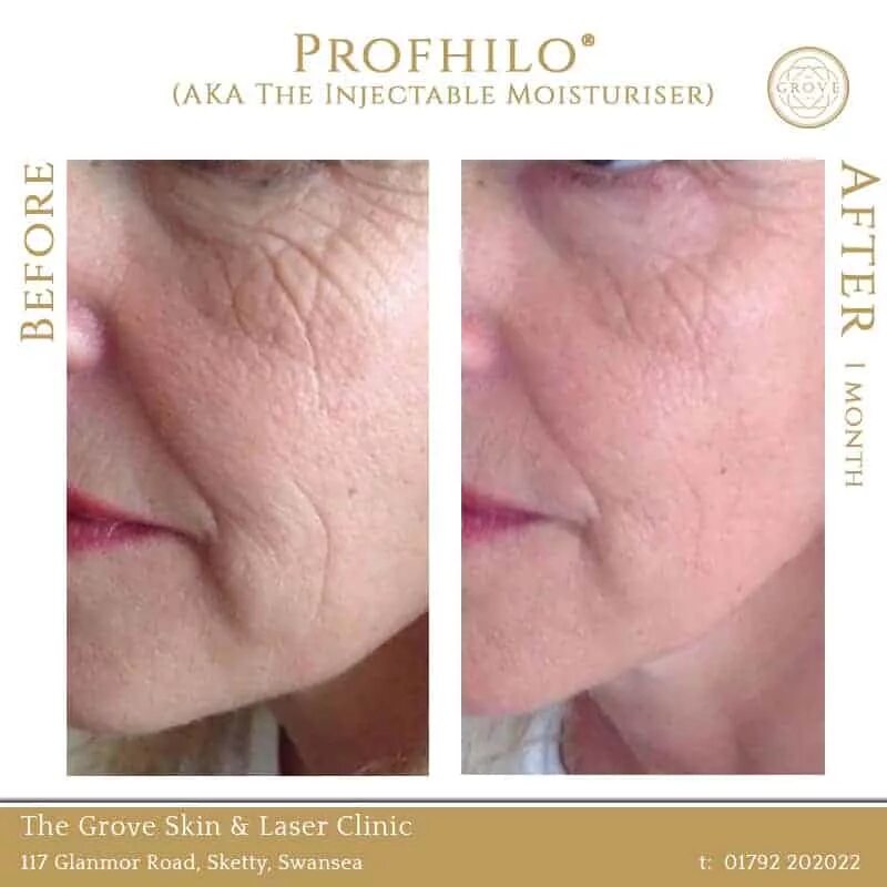 препарат профайло до и после. биоревитализация новокутан.