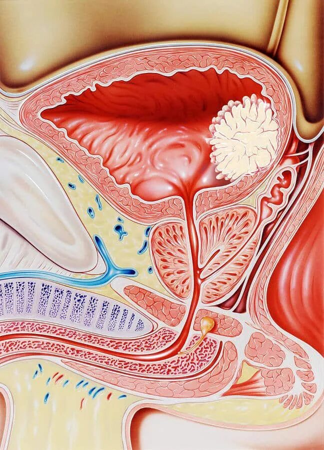 Воспалился простатит. Предстательная железа, Prostata. Карцинома предстательной железы. Мочевой пузырь. Простата у мужчин.
