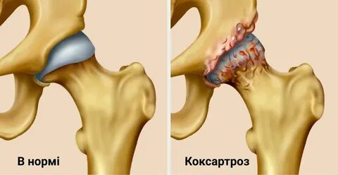 Коксартроз прогнозы