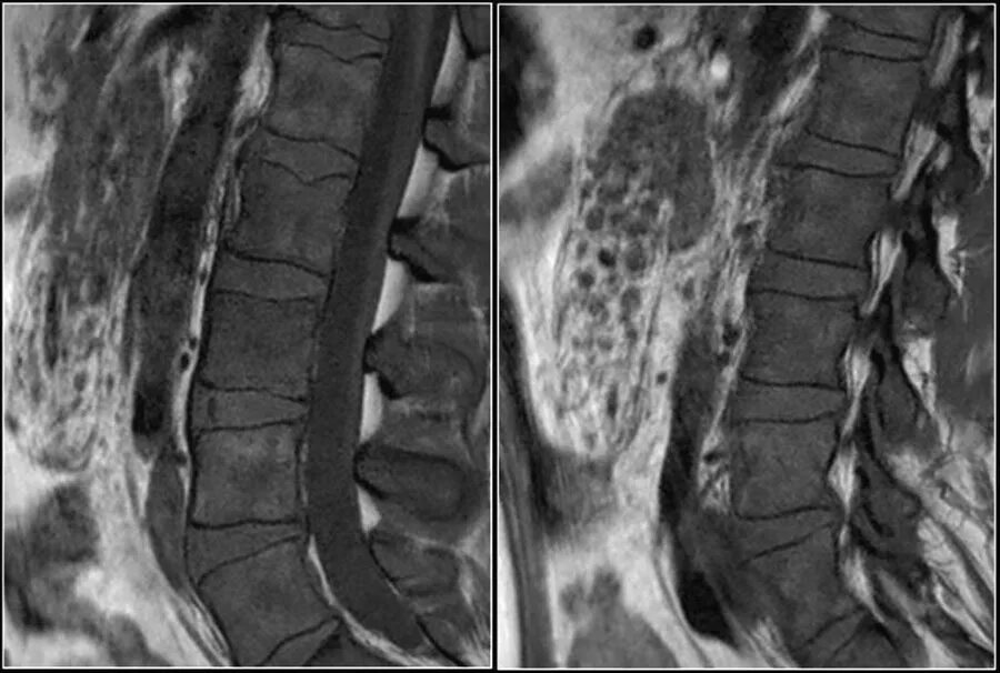 Грыжа мозговых оболочек освобождение нерва. Мрт позвоночника протрузия. Эпидурит позвоночника мрт. Рубцово-спаечный эпидурит мрт.