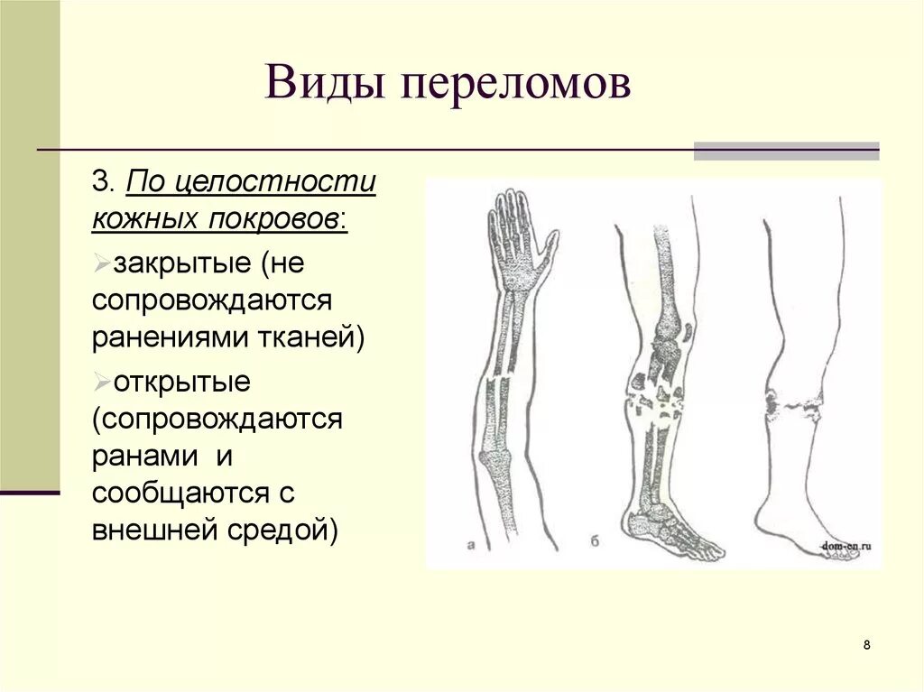 Степени открытого перелома. Виды перьев. Типы переломов конечностей.. Типы переломов костей конечностей.