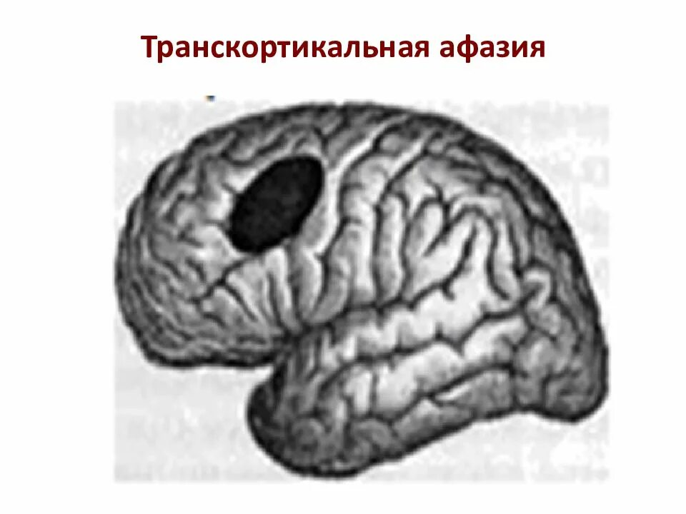 Проблема афазий